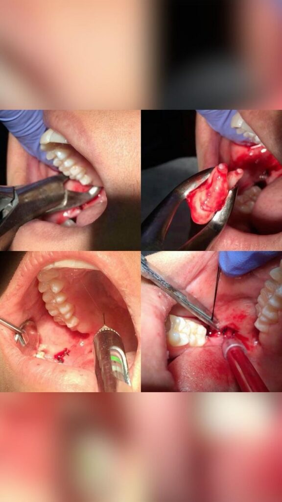 The Troublesome Trio: Understanding the Problems Caused by Third Molars and Their Treatment at Mint Dental Siwan